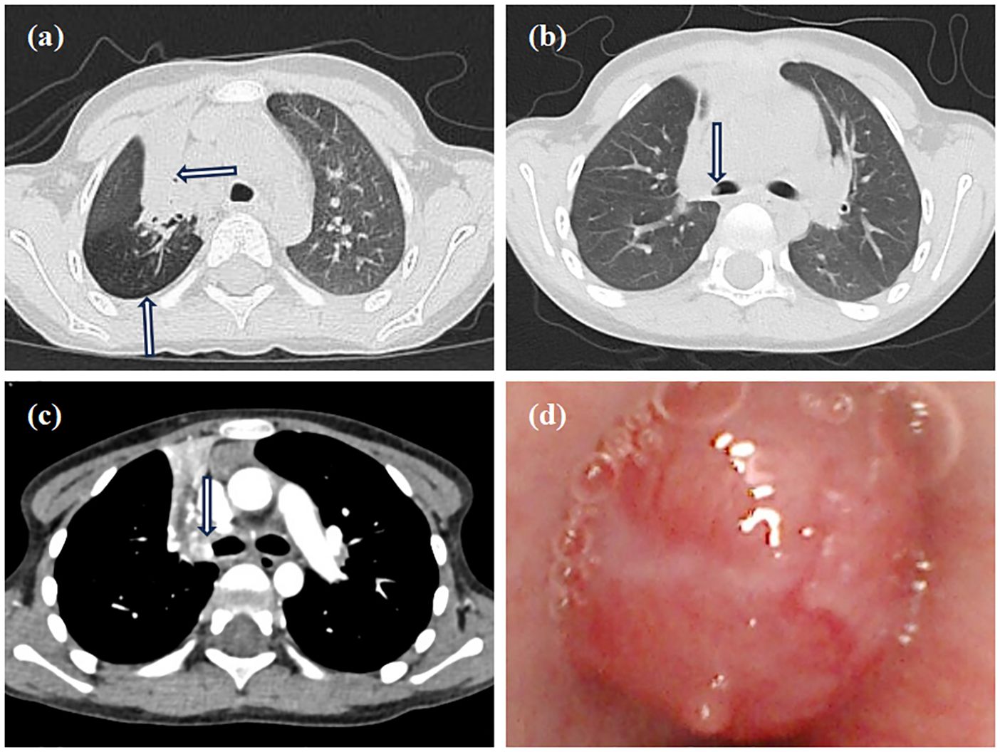 CT scan images and a bronchoscopic view of the chest. Image (a) shows arrows indicating areas in the lungs. Image (b) highlights another area with an arrow. Image (c) shows a different scan section with an arrow pointing at a highlighted spot. Image (d) displays a close-up view of the bronchial area with noticeable redness.