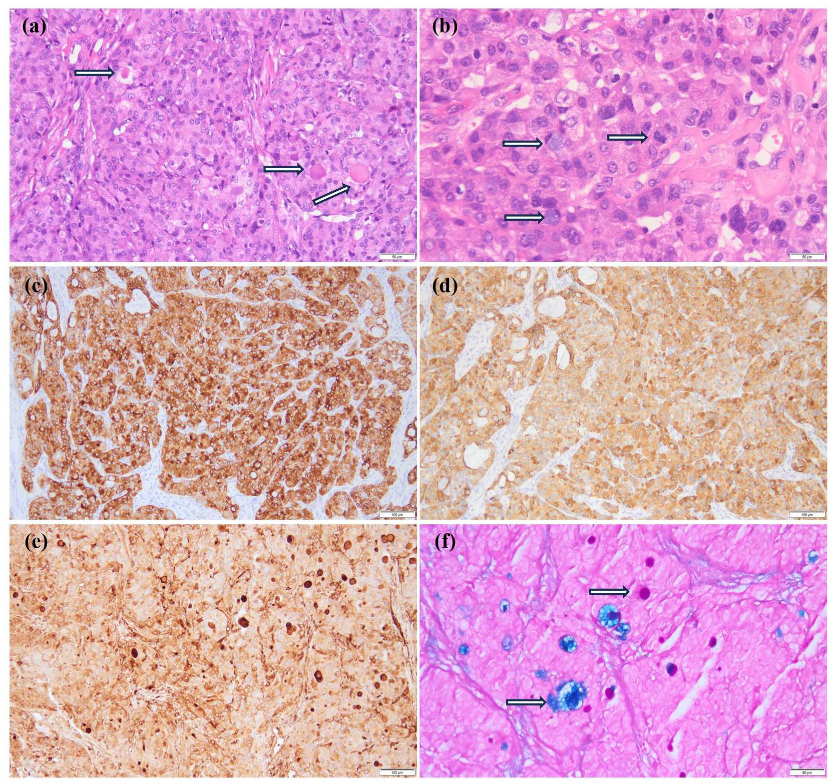Histological images showing liver tissue from a patient. Panel (a) displays eosinophilic, plump polygonal cells with distinct borders and some with granular cytoplasm (black arrows). Panel (b) shows similar appearances with sinusoidal fittings (black arrows). Panel (c) and (d) are tissue stained, exhibiting positivity for hepatocellular carcinoma markers. Panel (e) displays the expression of another marker with cytoplasmic reactivity. Panel (f) shows cells with a mix of basophilic and eosinophilic staining, highlighting areas of an amyloid-like appearance with arrows pointing to specific features.