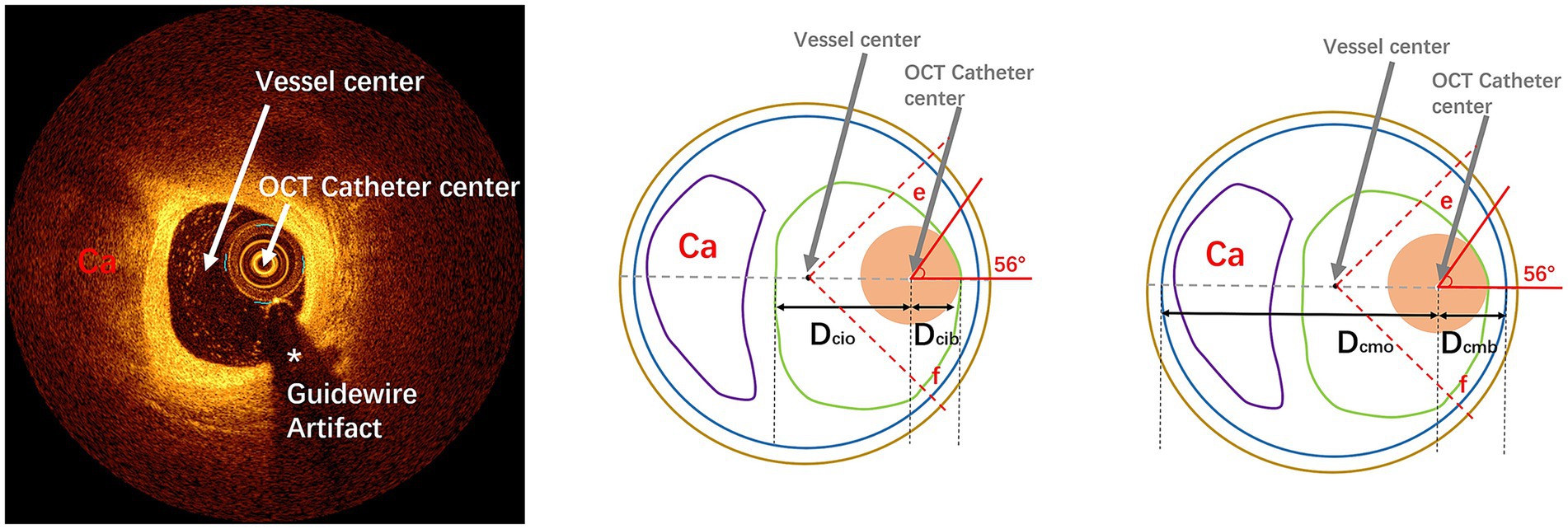 A side-by-side comparison: a medical imaging scan and a schematic diagram. The left shows an optical coherence tomography (OCT) image with labeled vessel and catheter centers, and a guidewire artifact. The right diagrams depict cross-sectional views, highlighting the positions of the vessel center, OCT catheter center, and measurements related to the calcified area (Ca) and angles.