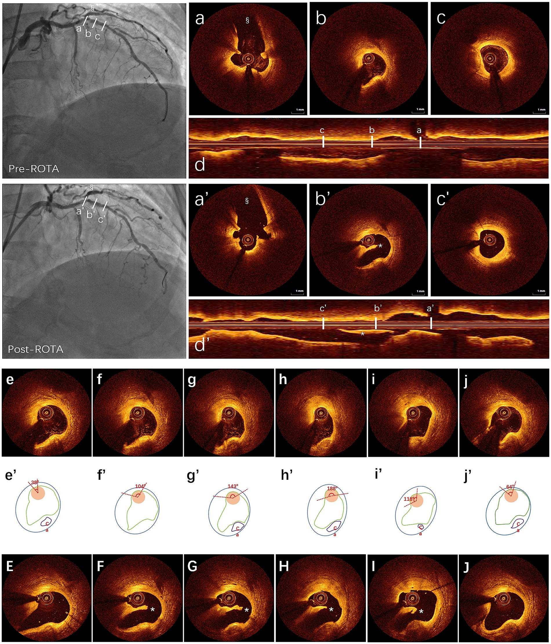 Pre- and post-ROTA angiographic and optical coherence tomography (OCT) images show coronary artery cross-sections. Panels a-c and a'-c' display circular OCT images, while d and d' show longitudinal artery sections, indicating pre- and post-procedure changes. Panels e-j and E-J depict further OCT images and diagrams, highlighting variation in arterial plaque morphology and distribution before and after rotational atherectomy.