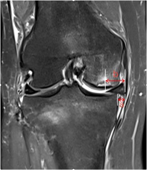 MRI scan of a knee joint showing internal structures. Red arrows indicate specific dimensions labeled \