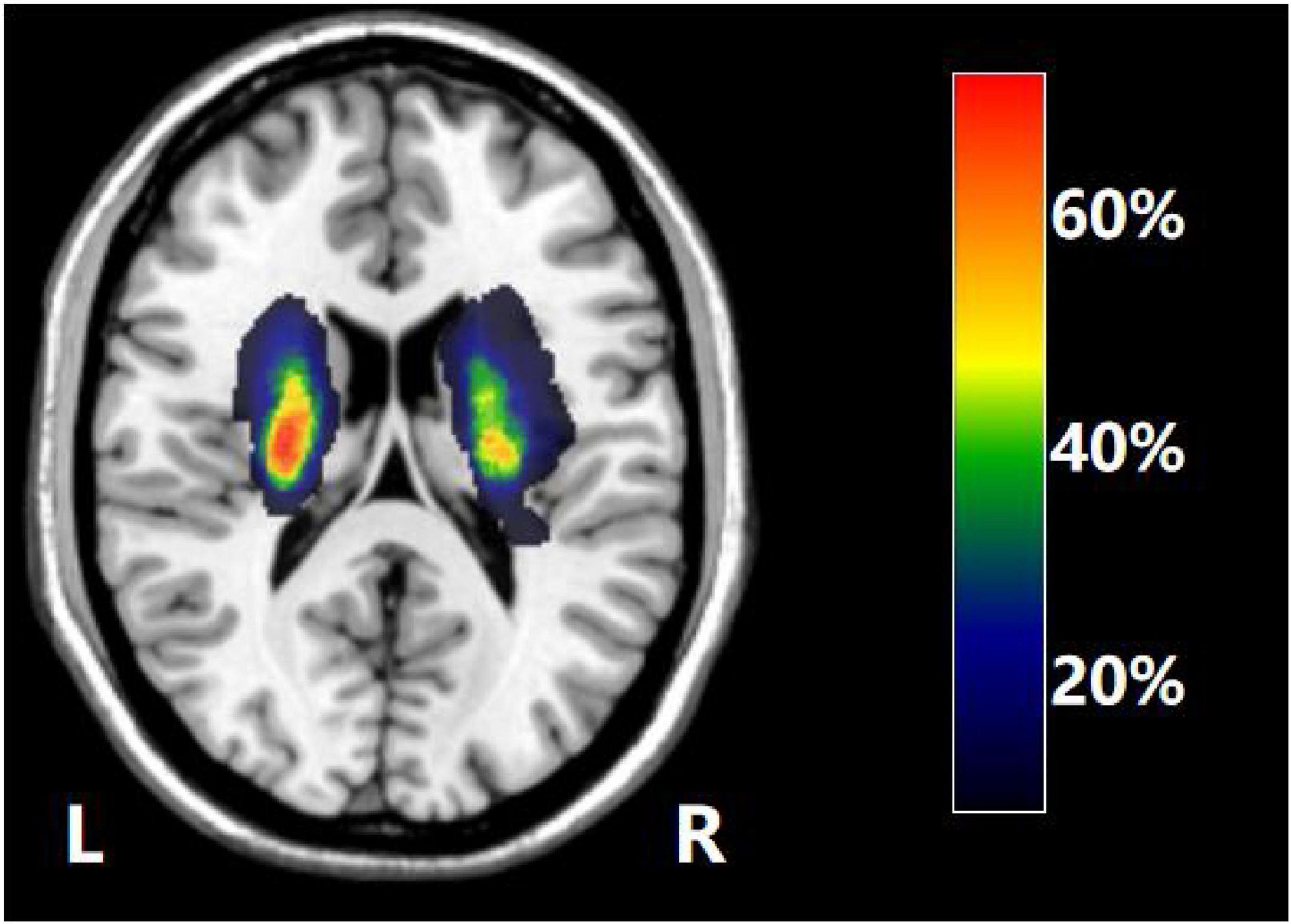 MRI brain scan showing color-coded areas indicating activity levels, with blue to red gradient representing twenty to sixty percent activity. Left and right hemispheres labeled “L” and “R” respectively.