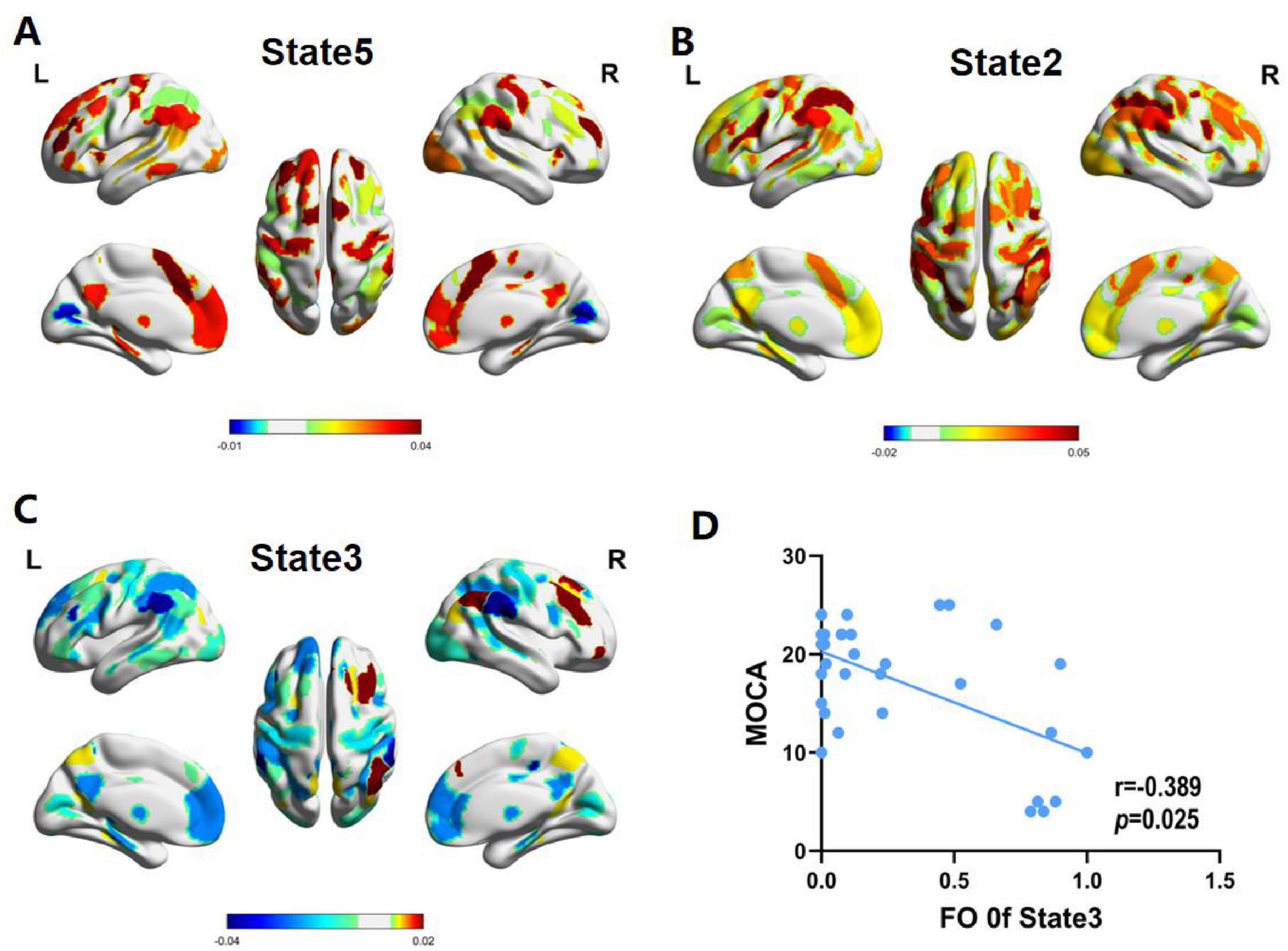 Panels A, B, and C display brain activation maps for States 5, 2, and 3, with regions colored according to activation intensity. Panel D presents a scatter plot showing a negative correlation between the fraction of time in State 3 and MOCA scores, with a correlation coefficient of -0.389 and a p-value of 0.025.
