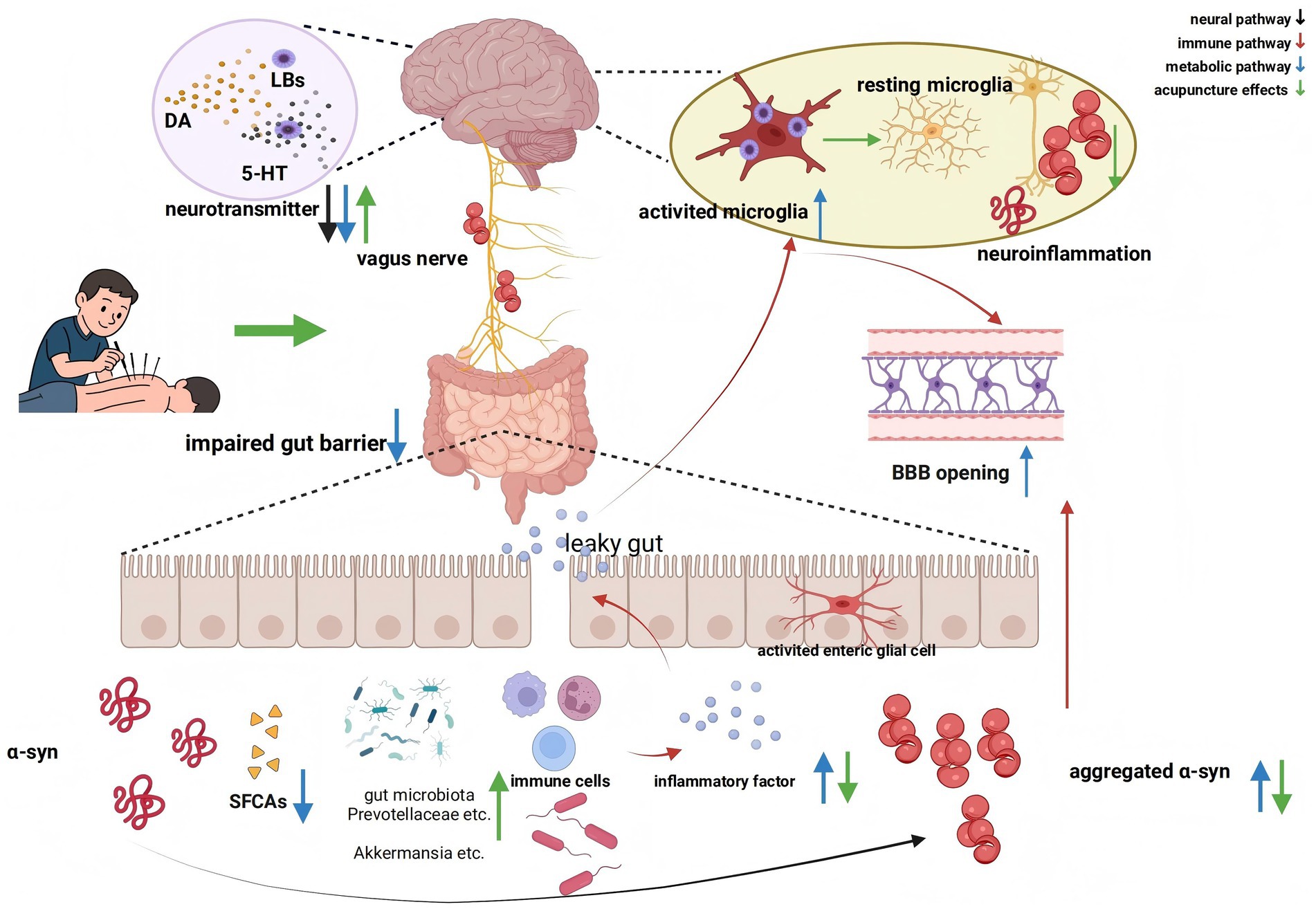 Illustration depicting the connection between the gut-brain axis and neuroinflammation, including elements such as the vagus nerve, neurotransmitters, gut barrier, leaky gut, immune cells, and aggregated alpha-synuclein. Acupuncture effects and pathways like neural, immune, and metabolic are illustrated with arrows. A patient receiving acupuncture is also shown, illustrating potential therapeutic effects.