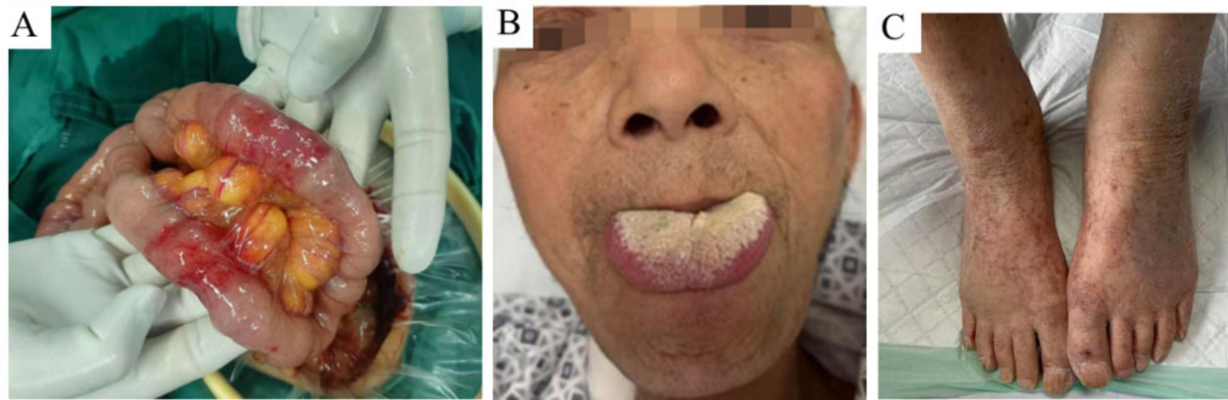 A. Close-up view showing extensive diffuse granulomatous edema and thickening of the small intestine observed during surgery. B. Close-up view of a person sticking out their tongue, with the tongue being thicker than that of a normal individual. C. Multiple ecchymoses on the skin of the feet and lower legs.