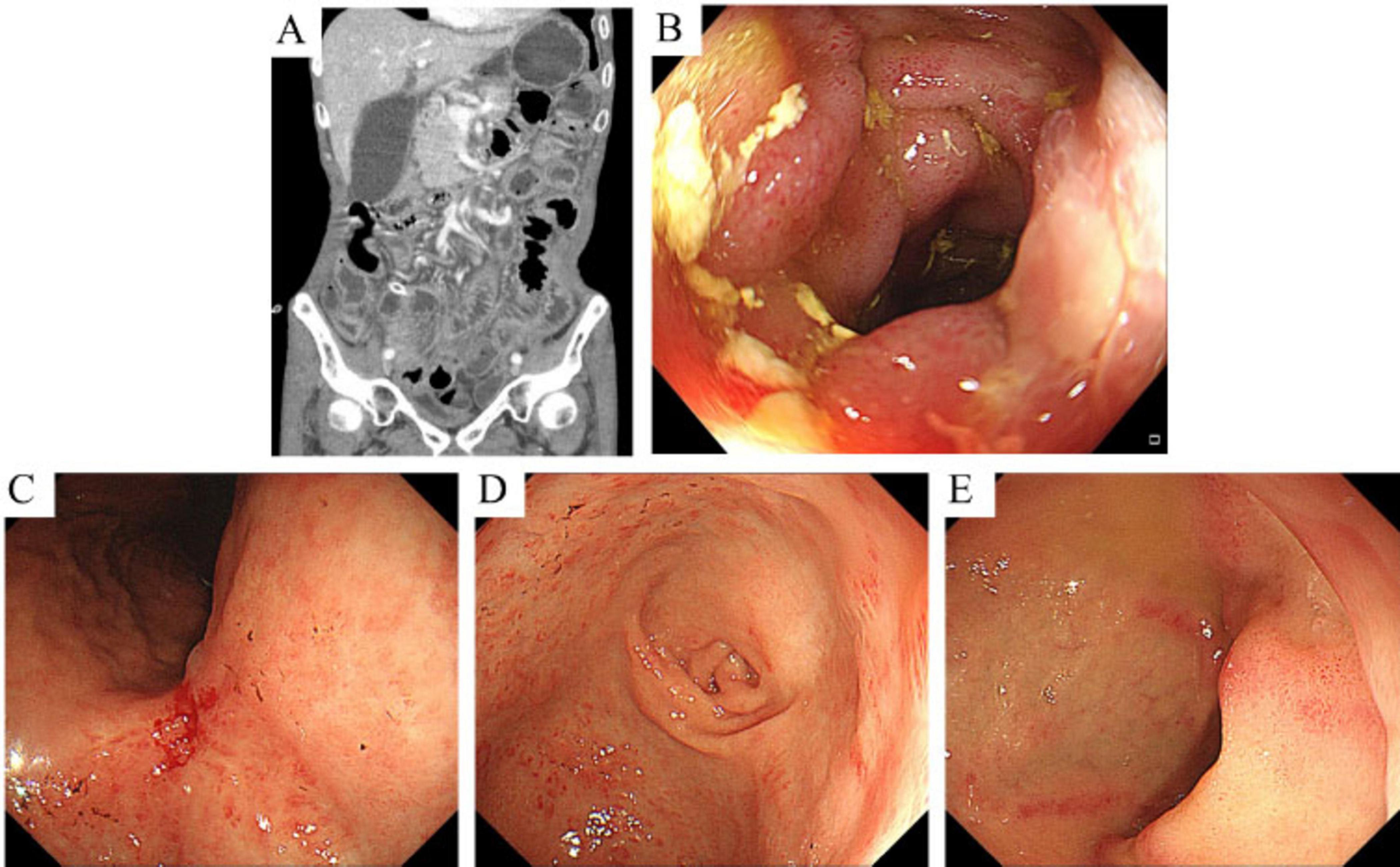 CT scan (A) showing abdominal structures with irregularities. Endoscopic images (B-E) depict the intestinal lining with inflamed, ulcerated regions and varying degrees of redness and lesions.