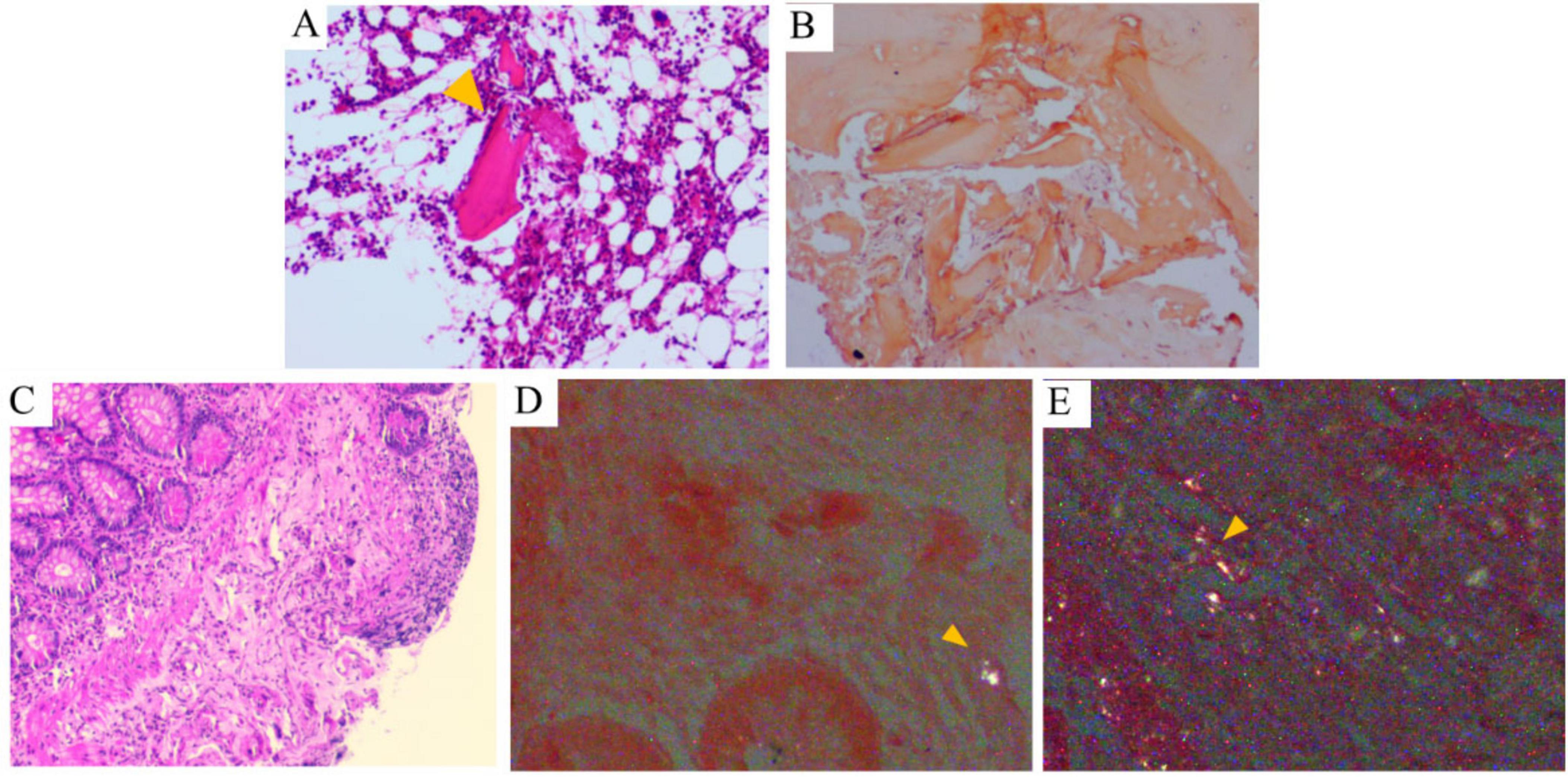 Histopathological findings of bone marrow and terminal ileum. A and B show bone marrow biopsy with Congo red staining, revealing pink, amorphous hyaline substances which exhibit apple-green birefringence under polarized light microscopy (×100); C shows terminal ileum biopsy with HE staining, demonstrating mild disorder of villous structure; D and E show Congo red staining of the submucosa of terminal ileum, revealing pink, amorphous hyaline substances that present apple-green birefringence under polarized light microscopy (arrows indicate positive areas).