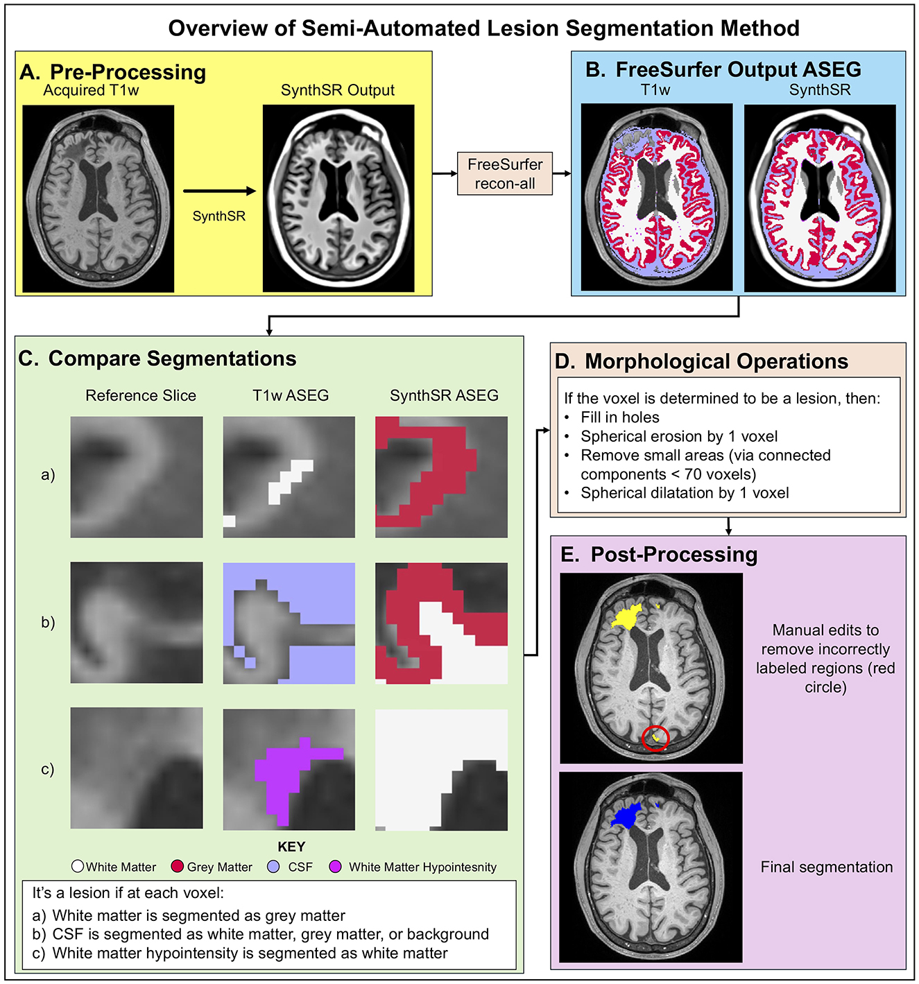 Overview diagram of a semi-automated lesion segmentation method. It includes five sections: (A) Pre-Processing with T1w and SynthSR images; (B) Freesurfer Output ASEG; (C) Comparison of segmentations with reference slices and color-coded categories (white matter, gray matter, CSF, white matter hypointensity); (D) Morphological operations listing steps for lesion determination; (E) Post-processing showing manual edits and final segmentation.