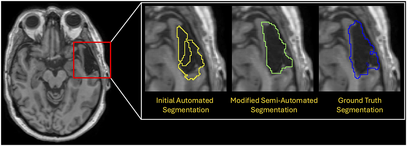 MRI scan showing a brain slice with a highlighted region; three zoomed-in segments compare segmentation methods. The first uses yellow outline for initial automated segmentation, the second uses green for modified semi-automated, and the third uses blue for ground truth segmentation.