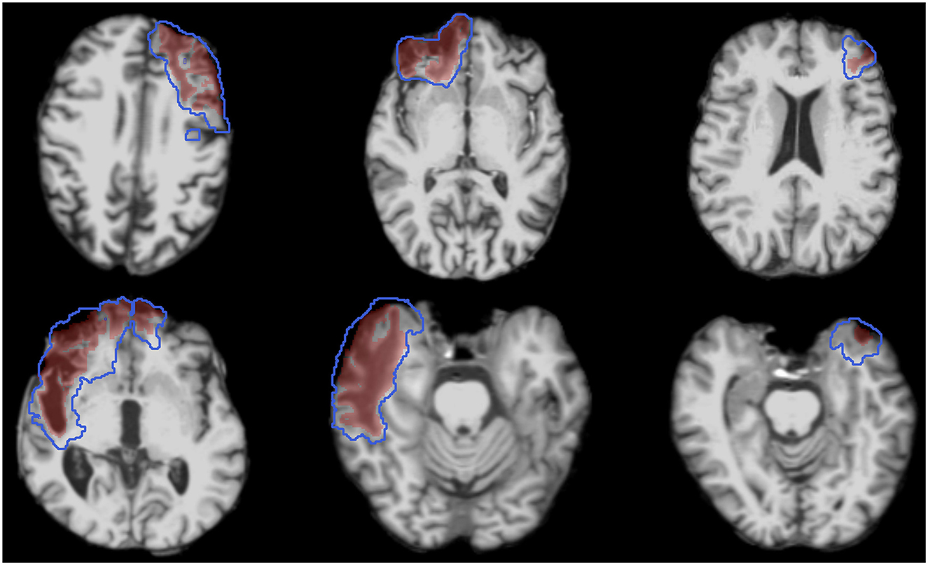 Six brain MRI scans in two rows show outlined regions highlighted in red to indicate specific areas of interest, possibly lesions or abnormalities. The highlighted areas are marked with a blue outline.
