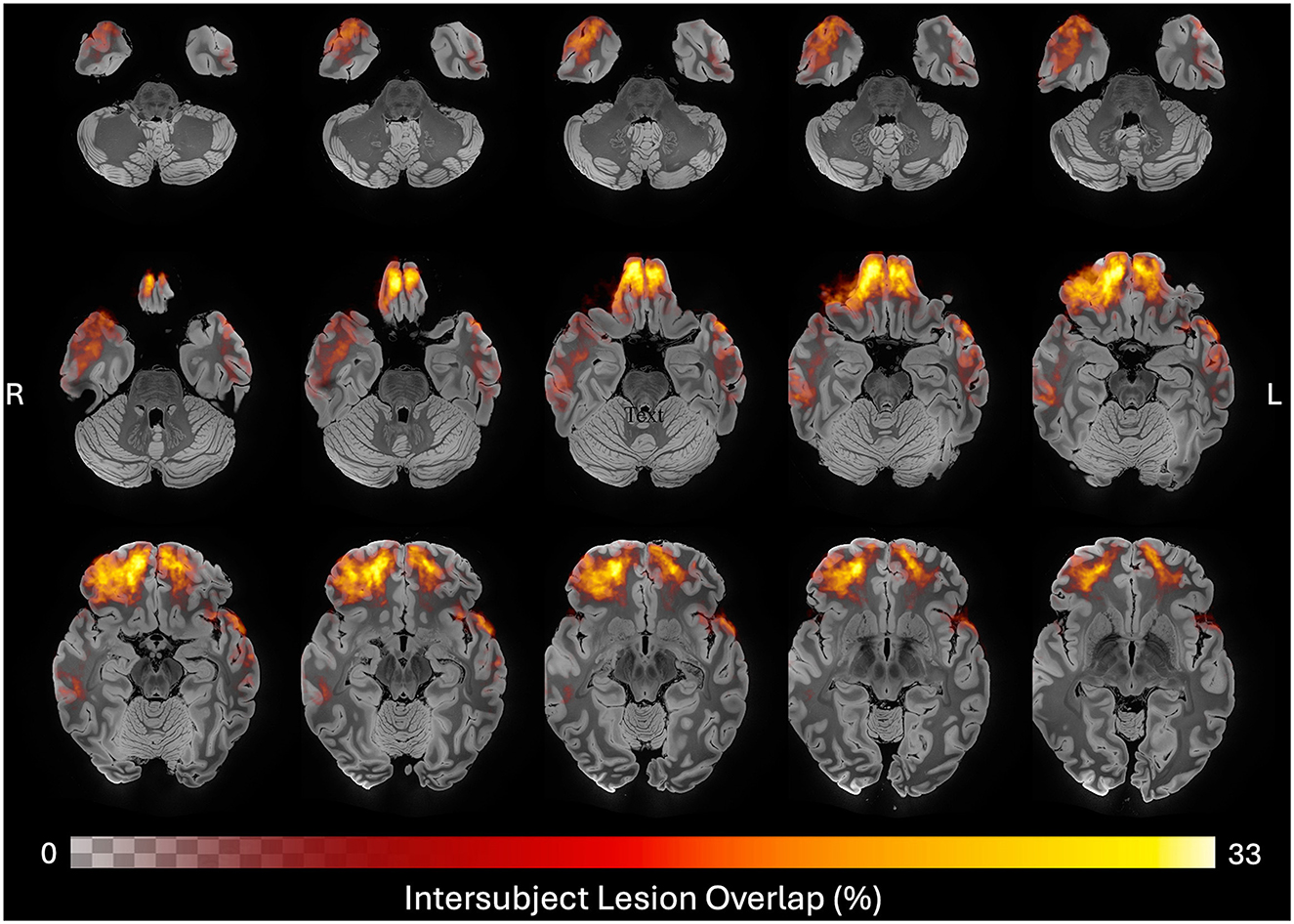 MRI brain scans show intersubject lesion overlap in various transverse slices. The lesions are highlighted in colors ranging from red to yellow, indicating different overlap percentages on a scale from zero to thirty-three percent.