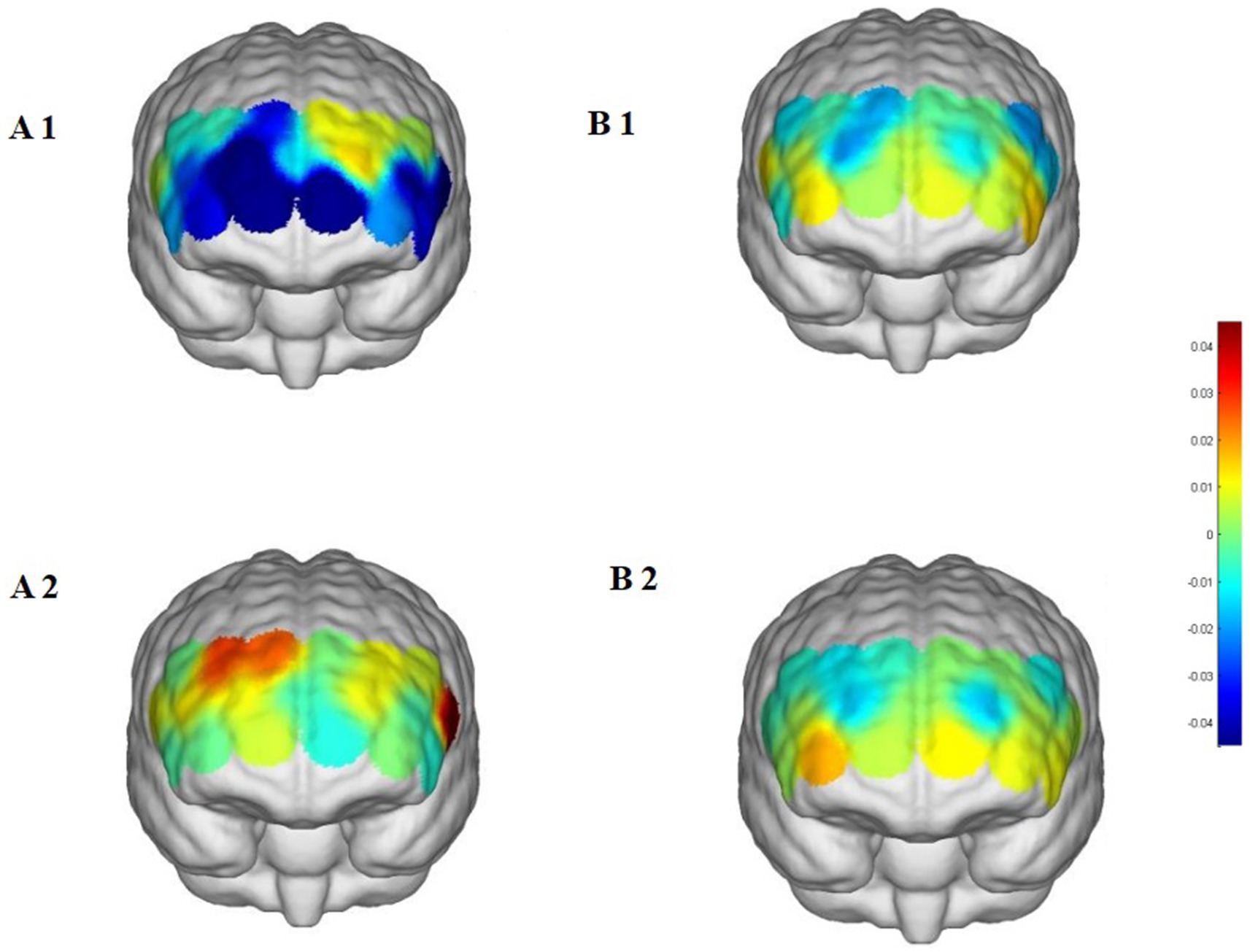 Four 3D brain models show color-coded data on the frontal cortex. Panels A1 and B1 display variations in blue to yellow, indicating data differences. Panels A2 and B2 exhibit changes from blue to red, following a similar pattern. A color scale on the right ranges from negative to positive values, marked in colors from blue to red.
