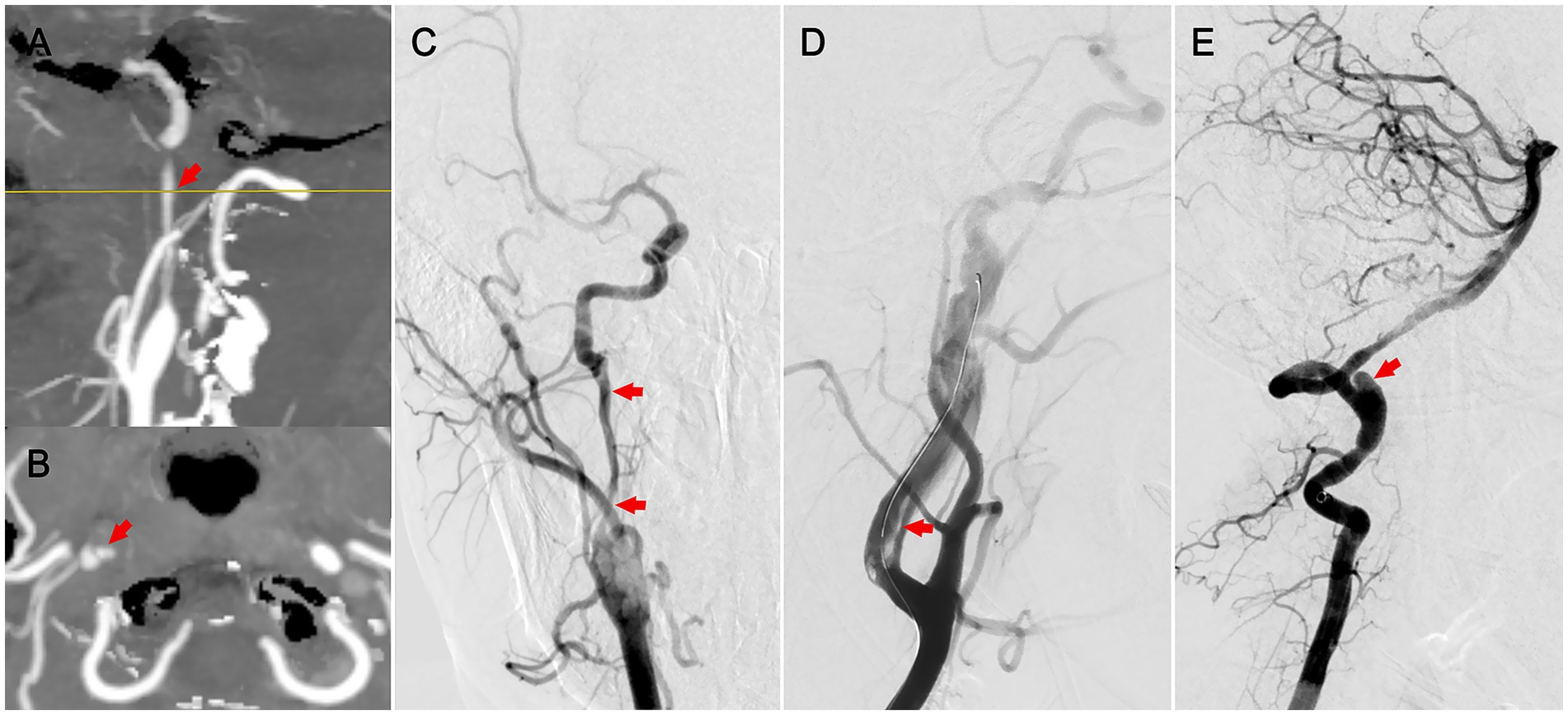 Composite image consisting of four medical scans labeled A, B, C, and E. Image A and B are grayscale, showing vascular structures with red arrows pointing to specific areas. Image C and E feature detailed angiograms with red arrows indicating areas of interest in the vasculature.