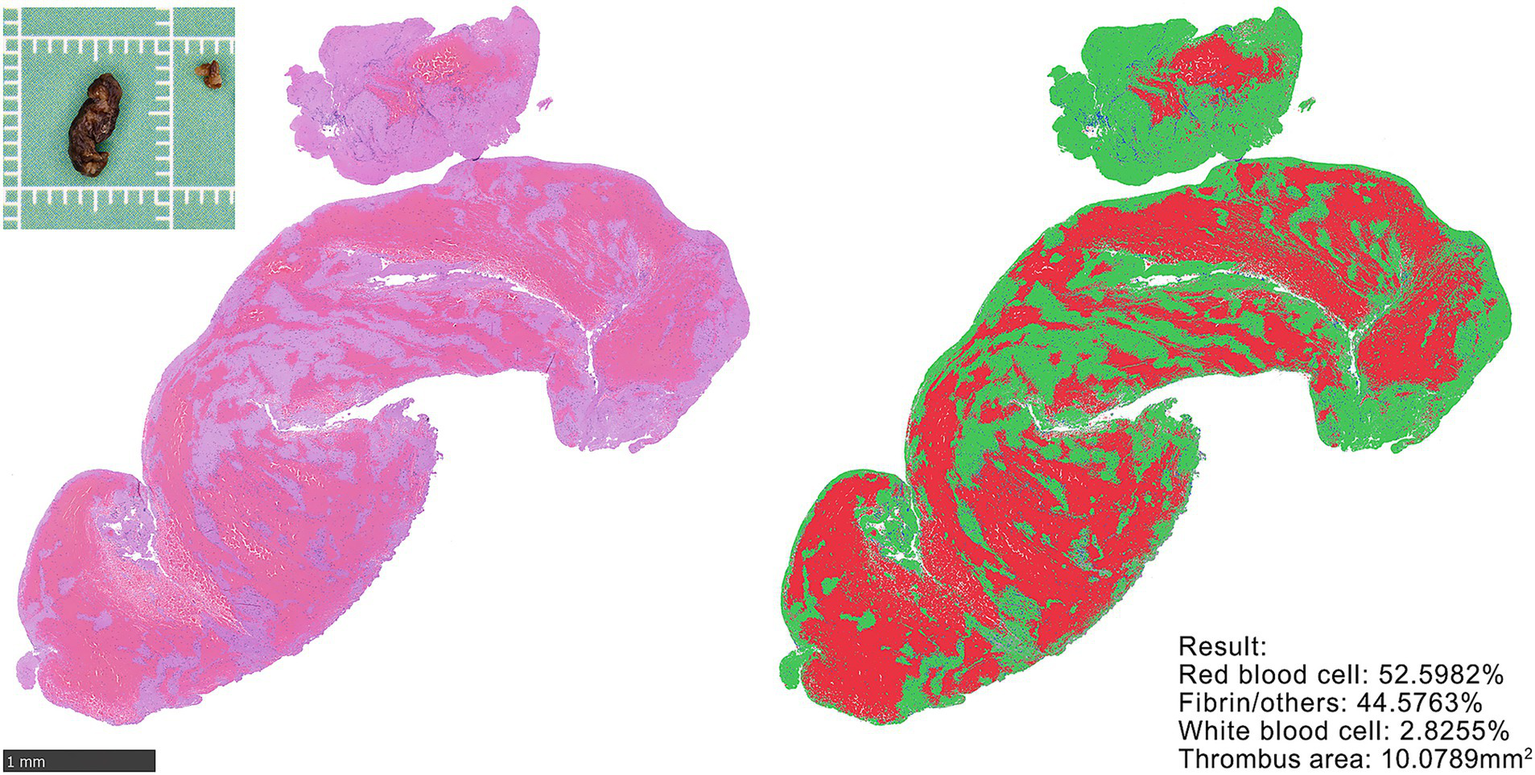 Photograph showing two images of a blood sample. The left image is stained in pink and purple, illustrating the composition of a thrombus. The right image shows a segmented version with colors red, green, and blue, representing red blood cells (52.5982%), fibrin and others (44.5763%), and white blood cells (2.8255%), respectively. A scale bar indicates the sample area is 10.0789 square millimeters. An inset displays the magnified portion of the thrombus.