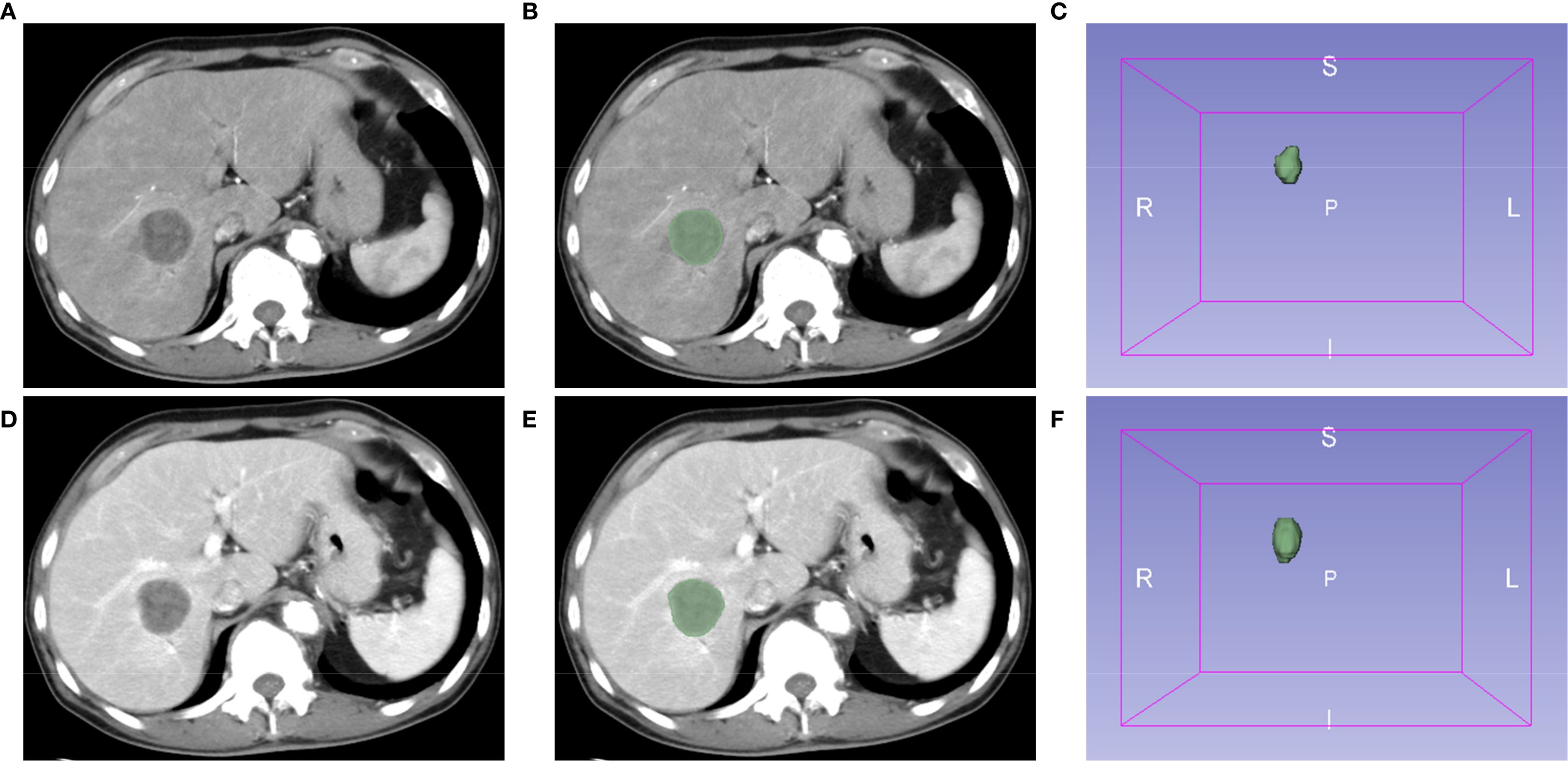 CT scan panels of the liver in axial view. Images A and D show the liver with circular regions of interest. Images B and E highlight these regions with green overlays. Images C and F are three-dimensional renderings indicating the orientation and position of the regions in the liver, with labeled axes: R (right), L (left), S (superior), I (inferior), and P (posterior).