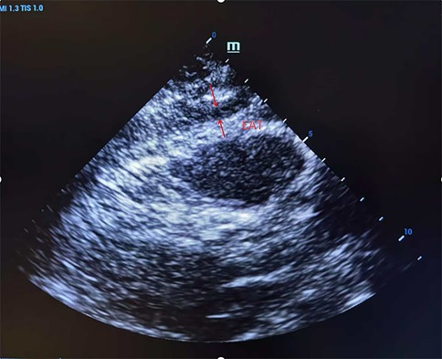 Ultrasound image showing the heart. Two red arrows point to specific areas labeled with \EAT\ in red text. The two red arrows denote epicardial adipose tissue thickness.