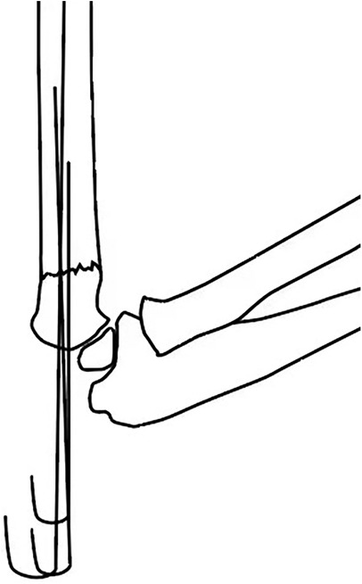 Illustration of a fracture in the bone, showing two bone fragments. The vertical black support lines represent external fixation devices applied to stabilize the fracture.