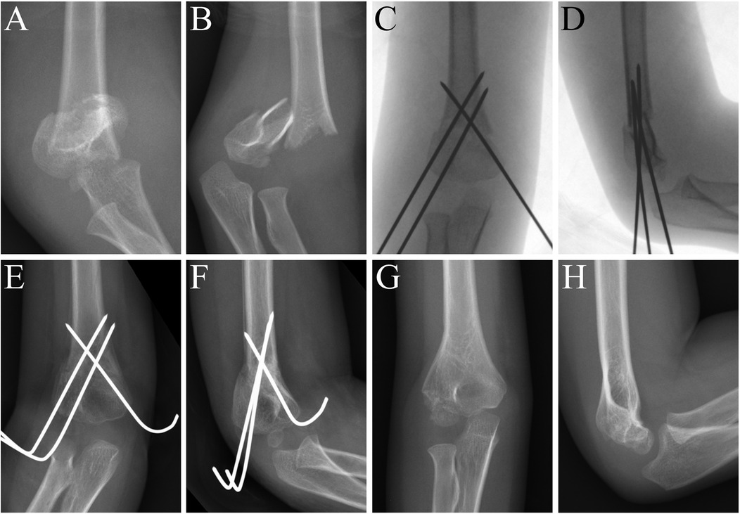 X-ray images of an elbow joint, displaying different stages and angles. Panels A and B show a fractured elbow. Panels C and D depict the placement of crossed fixation wires. Panels E and F illustrate wire fixation in a lateral view. Panels G and H show the healed elbow from different perspectives. Each panel (A through H) represents a distinct stage or view of the same medical procedure.