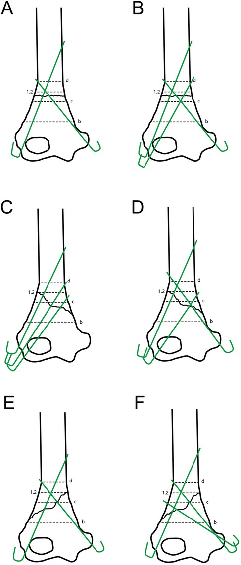 Diagrams A to F display different strategies of wire fixation for different forms of fracture on a frontal view of a humerus. Black lines represent fracture lines and green lines represent the wires. Dotted lines indicate the heights that the wires should reach.