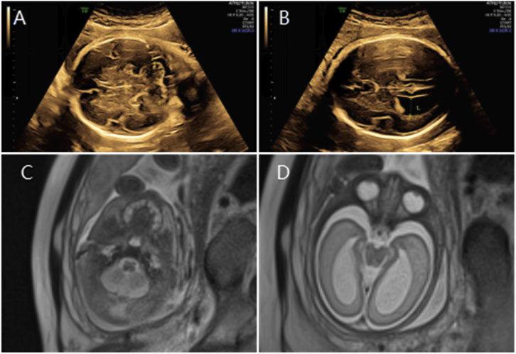 Ultrasound and MRI scans labeled A to D depict different views of a fetal head and brain. Images A and B show ultrasound scans with distinct circular shapes, potentially representing cranial structures. Images C and D are MRI scans presenting different levels of detail and contrast, emphasizing varying tissue densities in the fetal brain.