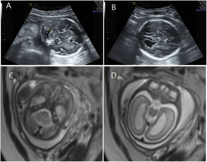 Ultrasound and MRI images are arranged in two rows. The top row shows ultrasound images labeled A and B, depicting a fetus in the womb with varying views. The bottom row displays MRI scans labeled C and D, providing detailed cross-sectional views of the fetus’s anatomy.