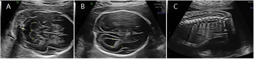 Ultrasound images labeled A, B, and C. Image A shows a cross-sectional view with various anatomical structures. Image B highlights a circular formation, possibly a head. Image C illustrates a series of vertical lines, suggesting spinal vertebrae.