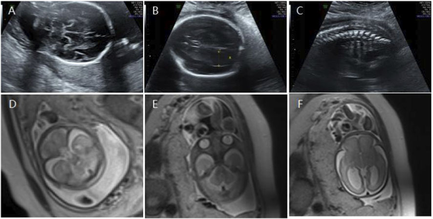 Ultrasound and MRI images labeled A to F. A, B, and C are ultrasound scans displaying different angles of a fetus. A shows a side view, B shows a circular head structure, and C displays the spine. D, E, and F are MRI scans showing axial slices of the fetal brain and body, indicating internal structures and development.
