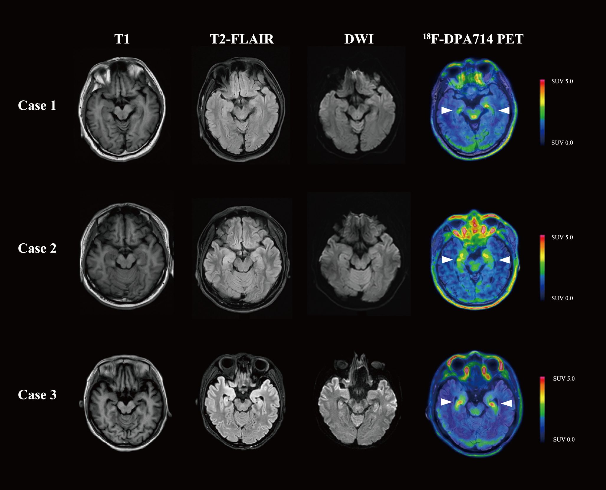 MRI and PET scans of three cases, each with four images: T1, T2-FLAIR, DWI, and ^18F-DPA714 PET. Arrows on PET images highlight areas with increased uptake. Right scale indicates SUV range from zero to five.