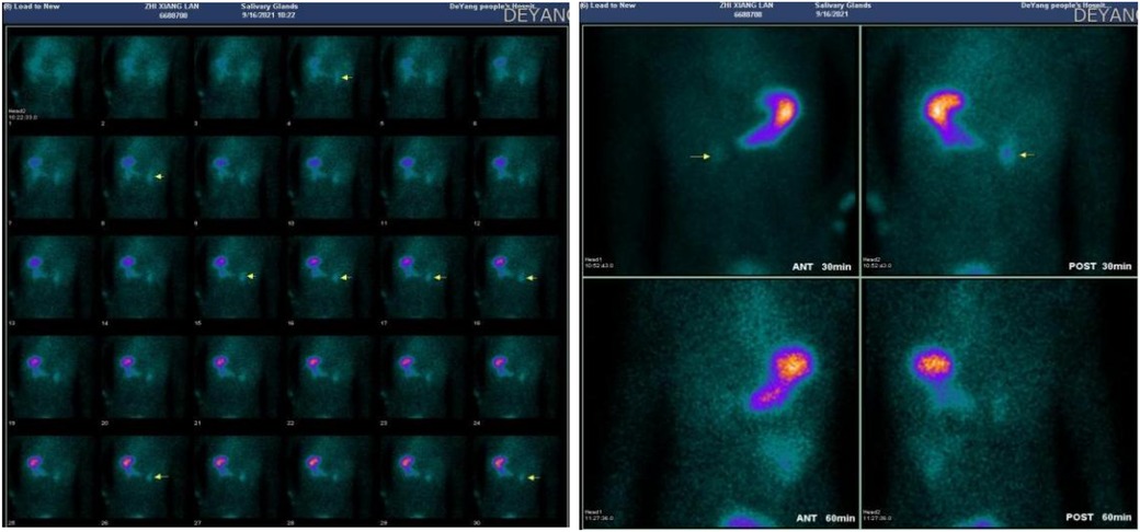Medical imaging scans showing salivary glands, featuring multiple time-lapse images on the left and detailed scans on the right labeled as \
