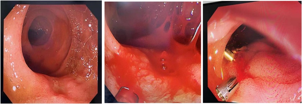 Three endoscopic images showing different views of the gastrointestinal tract. The first shows a clean, open passage, the second shows a close-up of reddish tissues, and the third shows a medical instrument inside, indicating a procedure or biopsy.