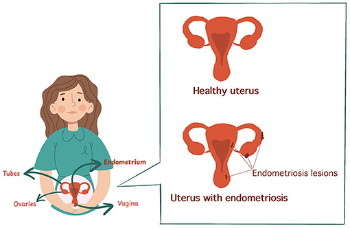 Illustration comparing a healthy uterus and one with endometriosis. The healthy uterus is shown as smooth, while the uterus with endometriosis has lesions. A woman is shown pointing to anatomical labels: tubes, ovaries, endometrium, and vagina.