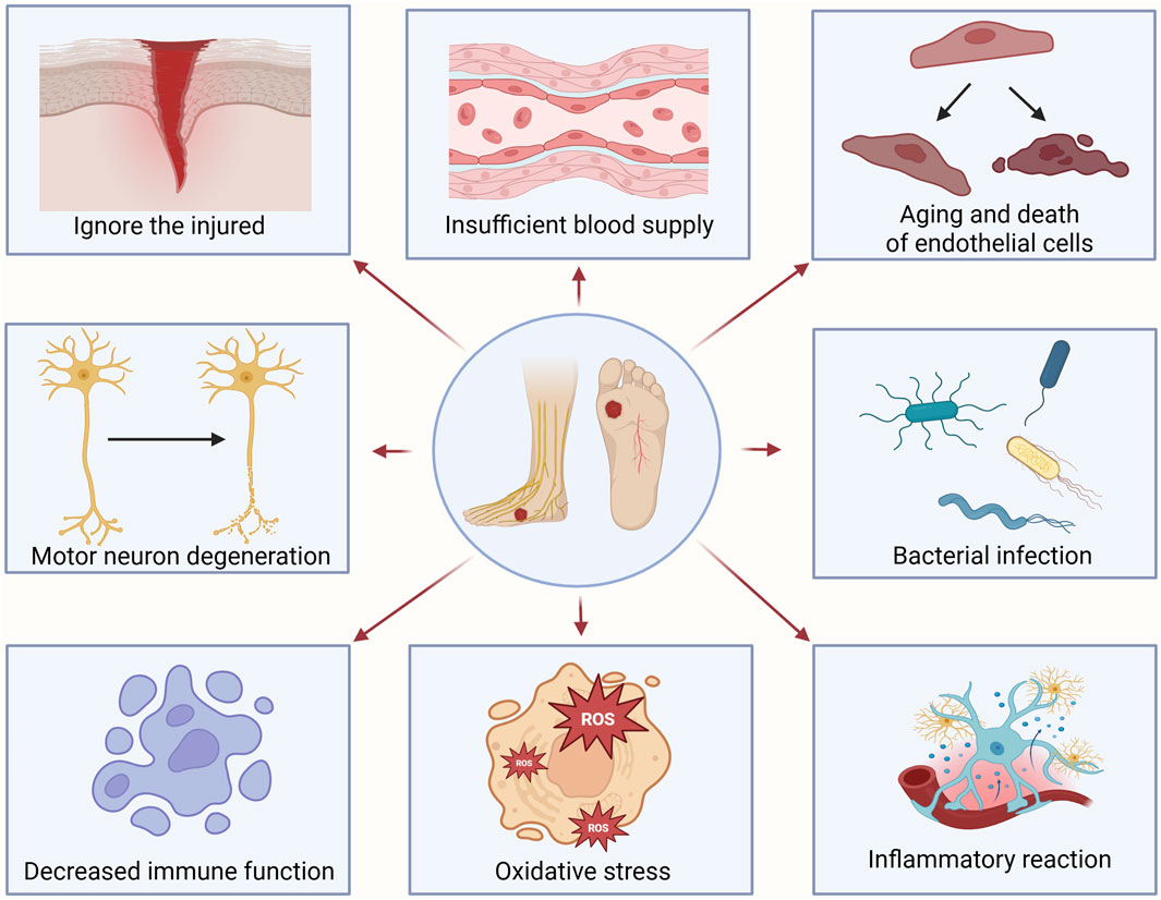 Diagram illustrating factors leading to foot injury, including insufficient blood supply, bacterial infection, oxidative stress, decreased immune function, motor neuron degeneration, aging of endothelial cells, and inflammatory reactions. Central image shows a foot with an injury.