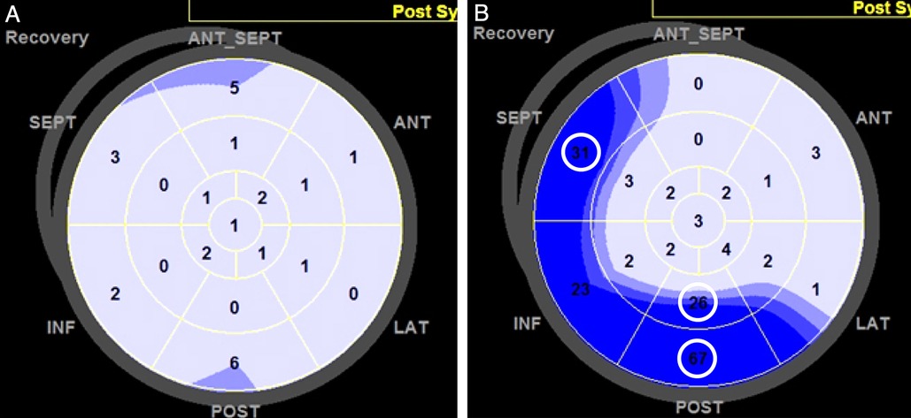 Two polar maps labeled A and B show the post-systolic index (PSI) distribution during the recovery phase of dobutamine stress echocardiography. Panel A displays uniformly low PSI values across all left ventricular segments, indicating a negative PSI. Panel B shows several left ventricular segments with higher PSI values (≥25%), highlighted with circles, indicating a positive PSI.