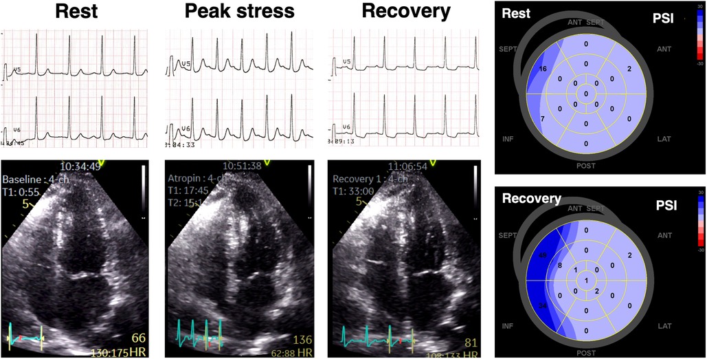 Echocardiographic and strain analysis images from a patient with anginal symptoms and marked ST-segment depression during dobutamine stress echocardiography, but without obstructive coronary artery disease on invasive angiography. The figure shows normal wall motion but elevated post-systolic index (PSI) values in several left ventricular segments.