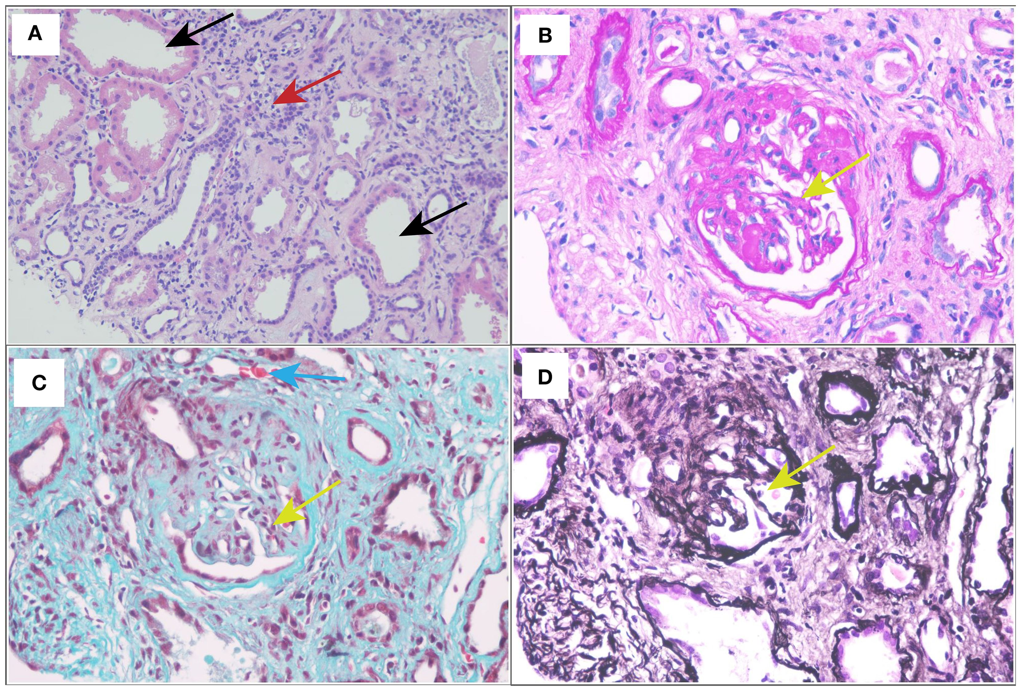 Microscopic images of kidney tissue samples in four panels labeled A to D. Panel A shows interstitial inflammation with arrows indicating areas of interest. Panel B highlights a glomerulus with a yellow arrow pointing to sclerosis. Panel C displays fibrotic changes, with a blue arrow indicating inflammatory cells and a yellow arrow pointing to glomerular changes. Panel D shows extensive fibrosis with a yellow arrow pointing to a glomerular structure. Each panel uses different stains to highlight specific histological features.