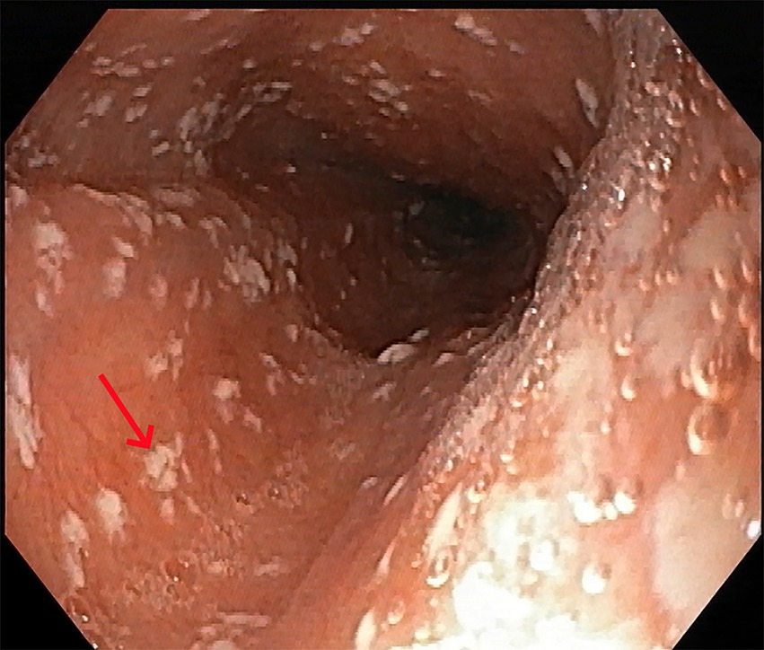 Endoscopic image of the esophagus showing white plaques on the mucosal surface, indicating possible inflammation or infection. A red arrow points to an area of interest.