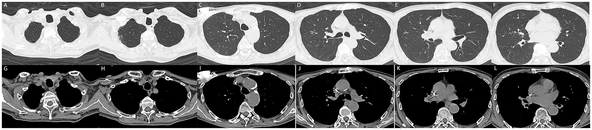 Two rows of CT scan images show different cross-sections of the thorax and lungs. The top row (A to F) displays images with a focus on lung tissue, highlighting variations in density and structure. The bottom row (G to L) emphasizes the mediastinum and surrounding anatomical features with different contrast levels. Each image offers a detailed view of the thoracic anatomy, useful for medical analysis.