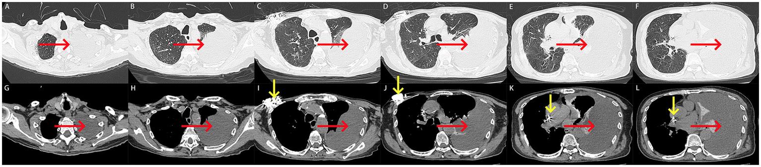 CT scan images show multiple cross-section views of the chest. Panels A to L feature both axial and cross-sectional images with red arrows indicating specific points in the lungs or surrounding areas. Yellow arrows in panels I, J, K, and L highlight different areas of interest. Each image illustrates varying densities and structures within the thoracic cavity.