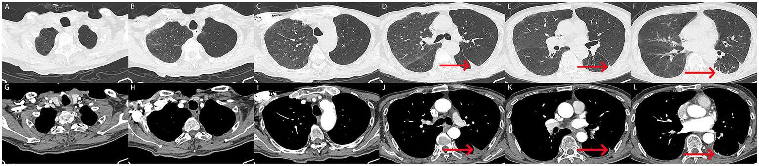 Upper and lower rows of CT scans show cross-sectional images of the thorax. Images A to F and G to L highlight lung and mediastinal structures. Red arrows in D, E, F, J, and L indicate specific areas of interest or possible anomalies.