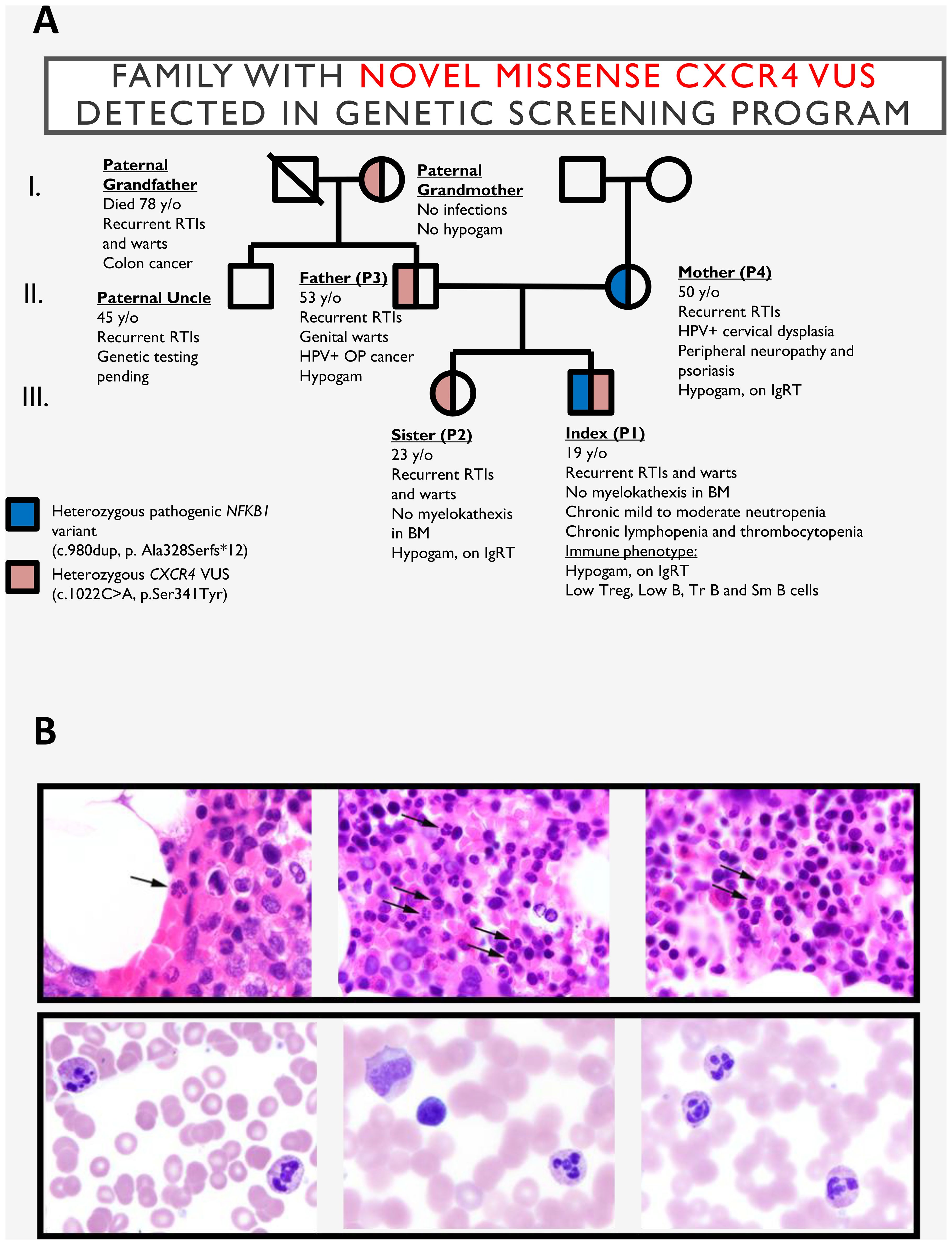 Pedigree chart titled “Family with Novel Missense CXCR4 VUS Detected in Genetic Screening Program” shows family members with recurrent respiratory tract infections, warts, cancers, and genetic variants including CXCR4 and NFKB1. The chart highlights affected individuals with red and blue symbols. Text describes individual health conditions, ages, and labels for genetic variants. The lower section, labeled “B,” contains four microscopic images of blood cells with arrows indicating abnormalities.