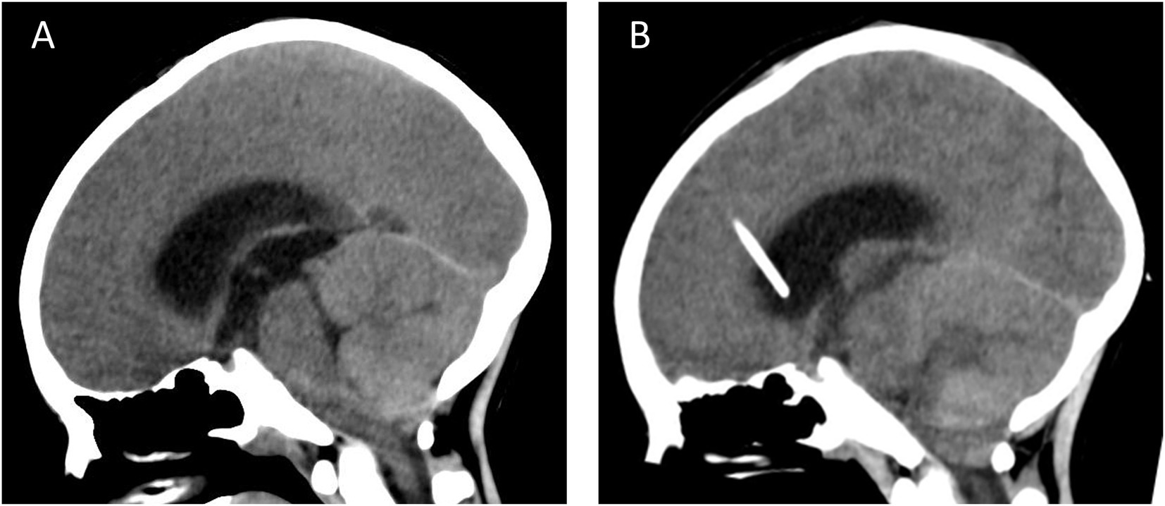 Two sagittal CT brain scans. Image A shows a normal brain structure without abnormalities. Image B depicts the insertion of an external object, resembling a catheter, into the brain.