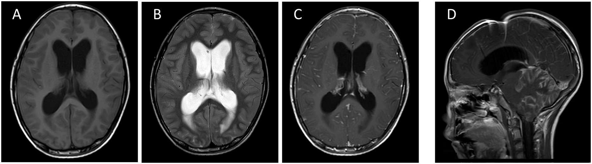 MRI scans show four different brain images: A) Axial T1-weighted, showing ventricles and brain structure. B) Axial T2-weighted, highlighting fluid-filled areas in white. C) Axial T1-weighted with contrast, emphasizing blood-brain interfaces. D) Sagittal T1-weighted with contrast, providing a side view of the brain's midline structures.