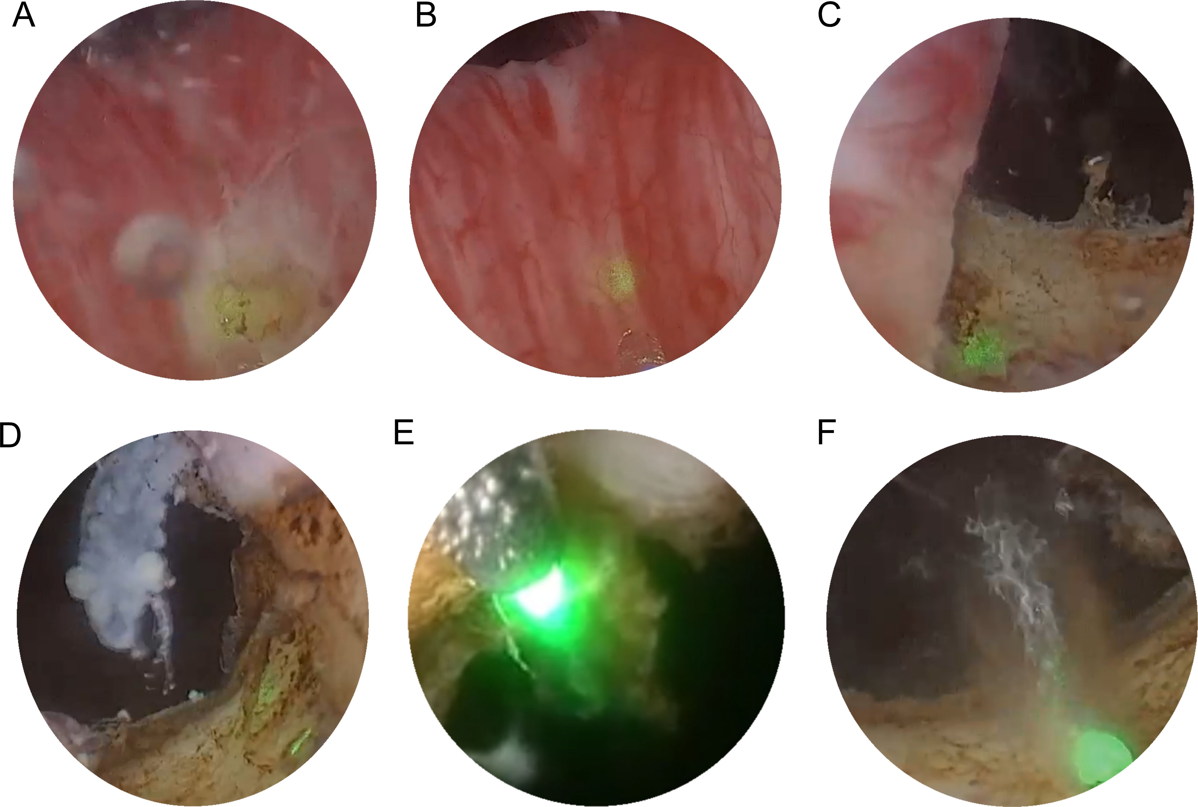 Panel A displays an ultrasound image of the spine with measurements marked. Panel B shows a surgical tool inserted into tissue with a focus on its positioning. Panel C depicts the surgical tool slightly angled differently, with a circular inset image illustrating an endoscopic view of the tissue.