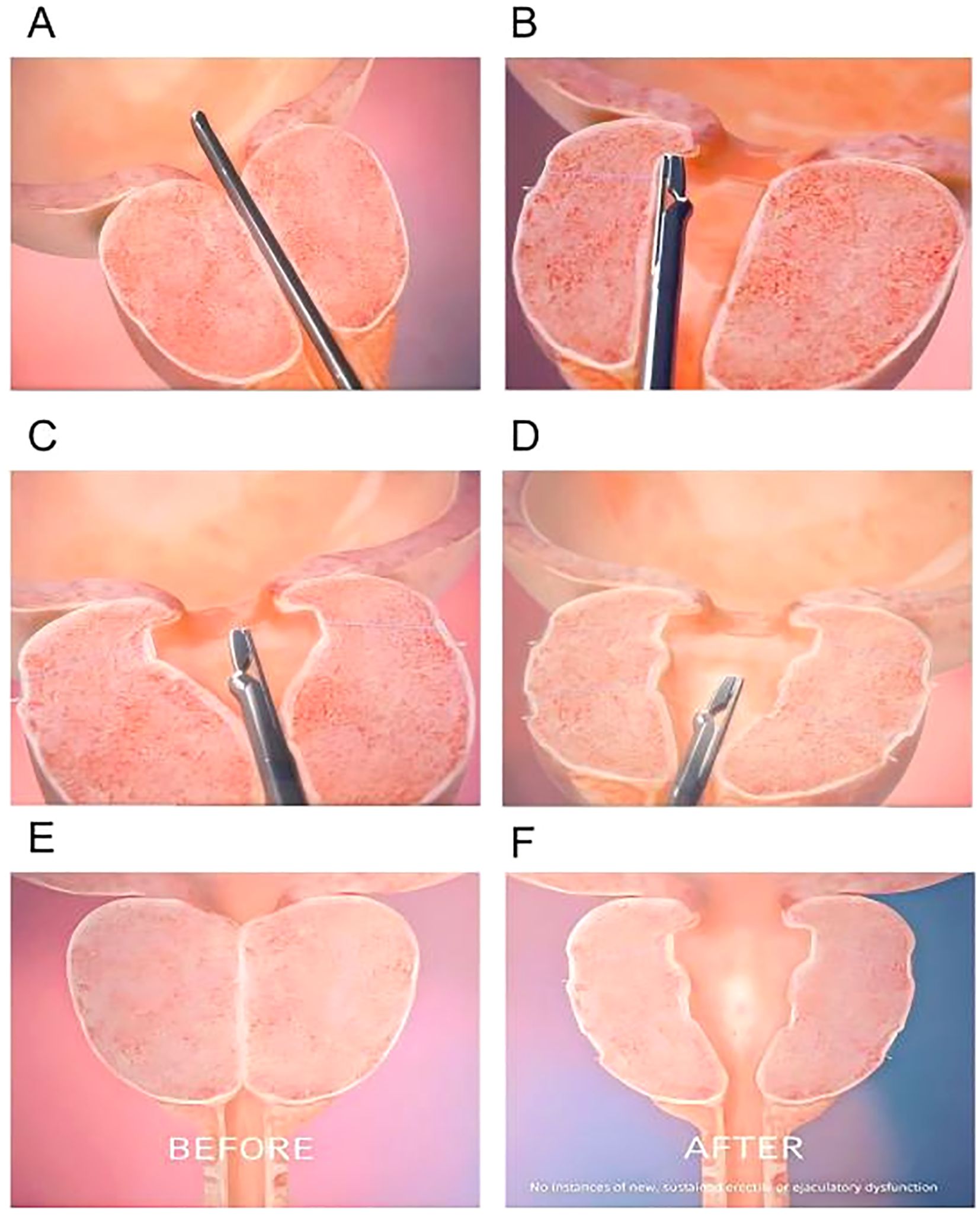 Illustration of a medical procedure. Panel A-F shows steps involving an instrument inserted between two lobes of tissue. Panel A-D depict incremental removal of tissue, widening the gap. Panel E shows the prostate before the procedure, labeled “BEFORE.” Panel F shows the prostate after the procedure with a wider space, labeled “AFTER,” noting no new instances of dysfunction.