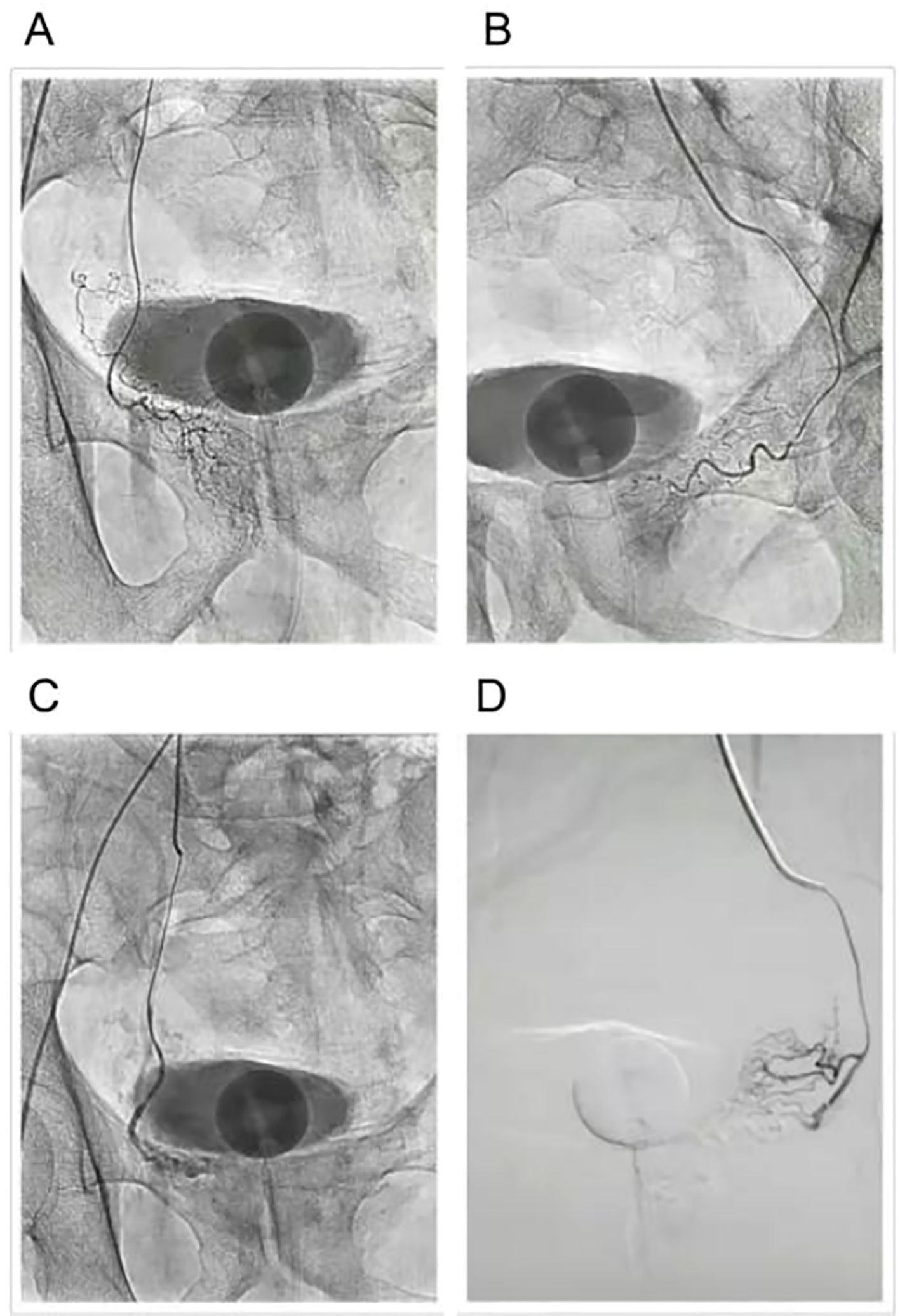 Three endoscopic images labeled A, B, and C show different views of internal anatomy. Image A depicts a clear view of two holding instruments. Image B shows a close-up of a red and white tissue section. Image C highlights a wider view with surrounding tissue. The images demonstrate the surgical process for tracheal resection.