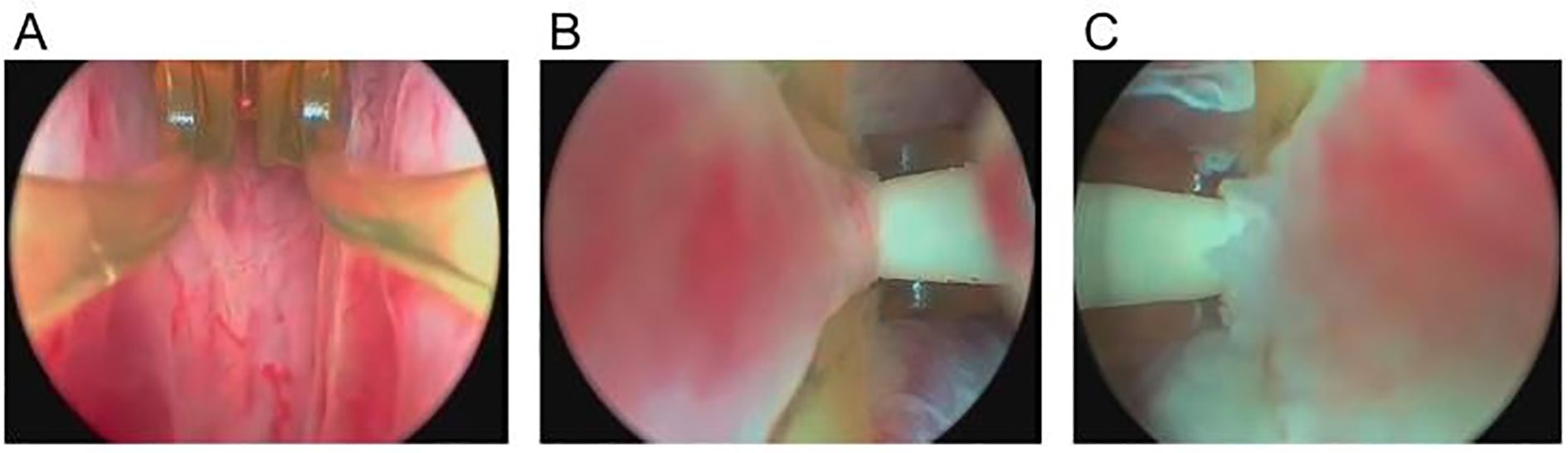 A four-part image depicting medical procedures: Panel A shows an illustration of a laryngoscope inserted into a patient's throat. Panel B displays a person in surgical attire holding a thin medical instrument. Panel C depicts a healthcare professional handling a long, slender medical device. Panel D shows the interior view of a throat as captured by an endoscopic camera.