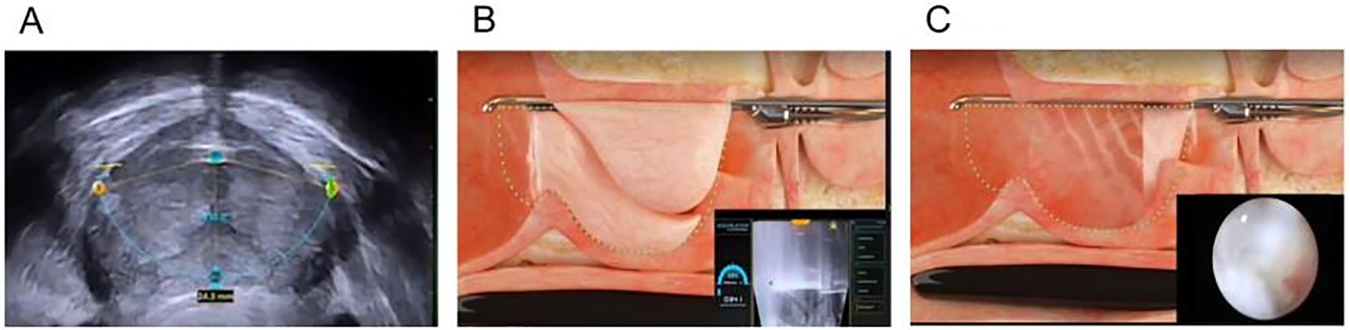 Series of four angiographic images labeled A to D, showing different stages of catheter placement and vascular visualization. Image A and B display catheter insertion near a round, darkened area with visible blood vessels. Image C shows a catheter positioned without significant contrast. Image D illustrates a more distal view with detailed vascular branching.