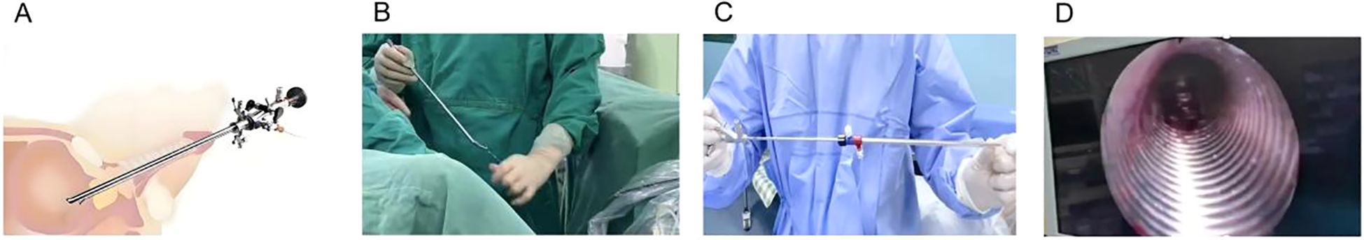 Six-panel image showing endoscopic views of different stages in a medical procedure in the biliary tract. Panel A and B display a slightly inflamed area with reddish tissue. Panel C shows a small, localized green area, possibly indicating contrast or fluorescence. Panel D has a white and possibly calcified area adjacent to dark tissue. Panel E shows a bright green light illuminating a section of tissue, indicating active intervention. Panel F displays a pale tissue surface with a bright green spot at the bottom, suggesting the procedure's completion phase.