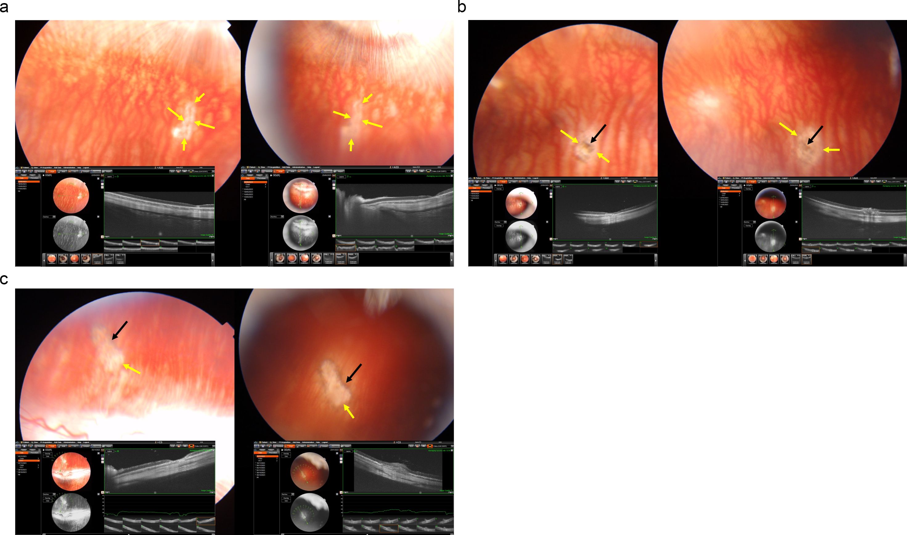 Close-up images showing retinal examinations with yellow and black arrows pointing to specific areas. Each panel includes optical coherence tomography (OCT) scans below the main images, providing detailed cross-sectional views of the retina. Panels are labeled A, B, and C, displaying variations in retinal structure and highlights.