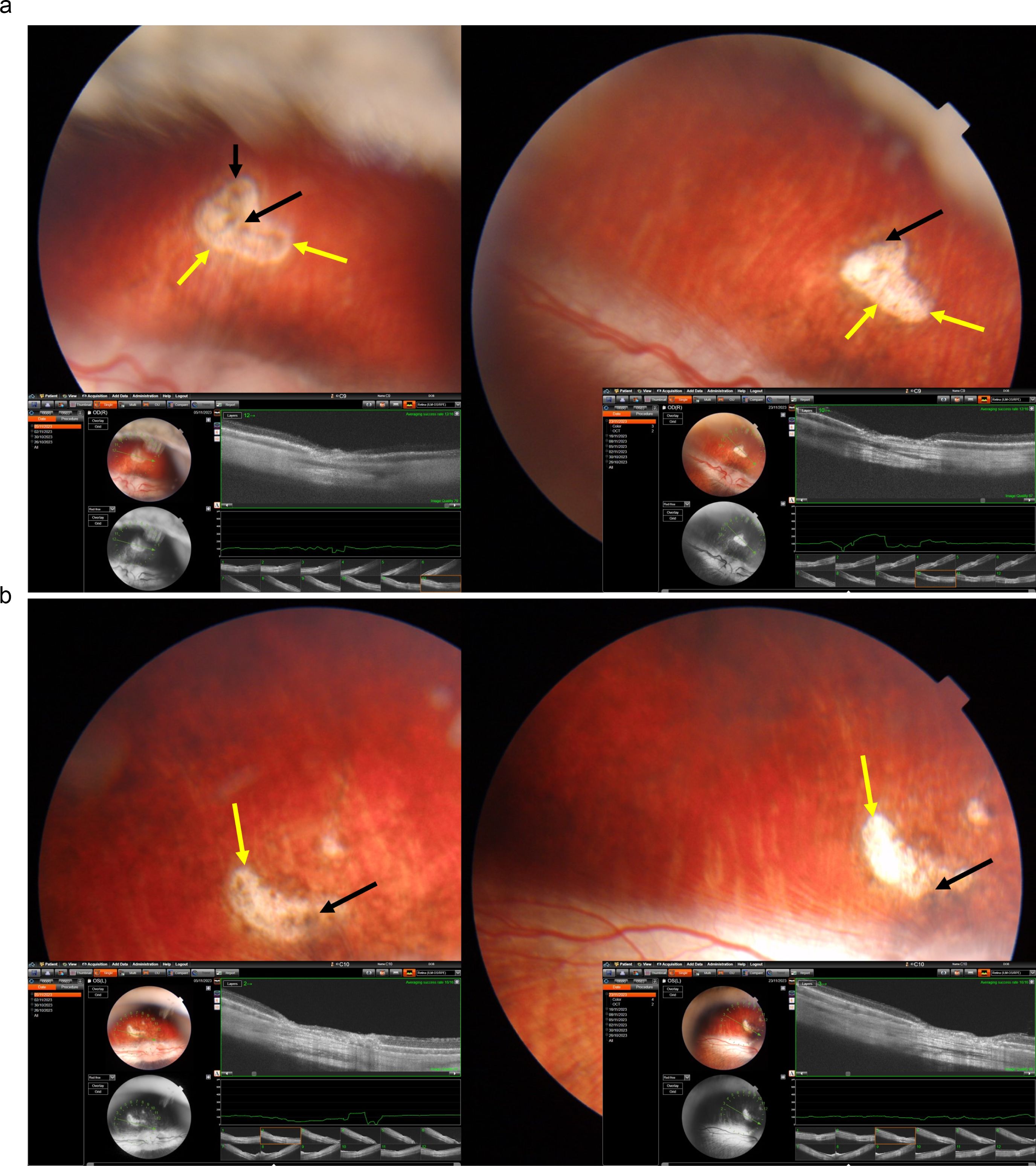Images A and B show retinal scans with highlighted areas. In A, yellow and black arrows indicate areas of interest with detailed OCT scan data visible below. In B, similar retinal features are marked with arrows, also displaying OCT data below for comparison. The images focus on specific retinal abnormalities or structures.